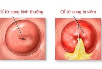 phuong-phap-giup-hon-1-000-nguoi-thoat-khoi-can-benh-viem-co-tu-cung
