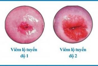 nguyen-nhan-gay-viem-lo-tuyen-co-tu-cung