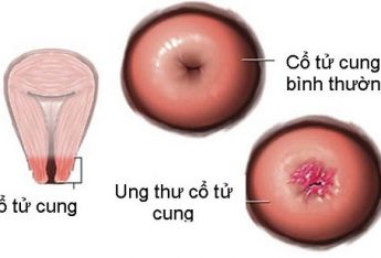 viem-lo-tuyen-co-tu-cung-tong-quan-nhung-kien-thuc-can-biet