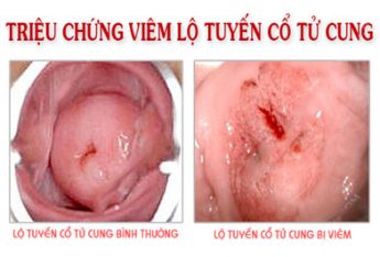 viem-lo-tuyen-co-tu-cung-co-nen-dot-khong