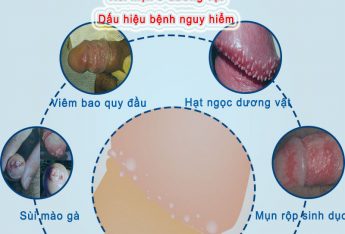 duong-vat-noi-mun-la-benh-gi