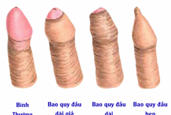 cach-khac-phuc-hep-bao-quy-dau-hieu-qua-nhat