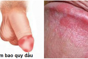 tong-hop-tat-ca-nhung-can-benh-nam-khoa-ma-nam-gioi-thuong-gap-phai