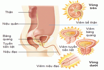 tong-quan-nhung-kien-thuc-co-ban-can-biet-ve-can-benh-viem-duong-tiet-nieu