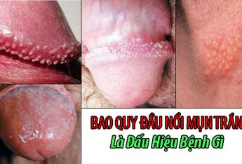 lo-lang-bao-quy-dau-noi-mun-la-benh-gi