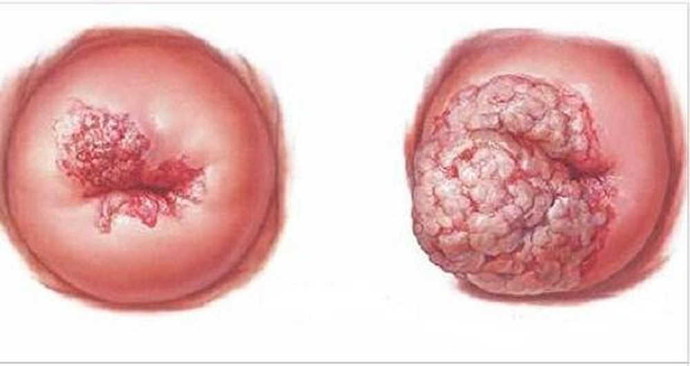 Nguy cơ ung thư cổ tử cung do mắc phải viêm cổ tử cung