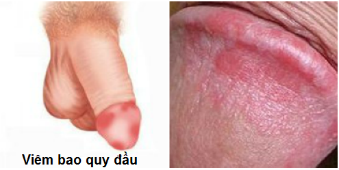 viêm bao quy đầu