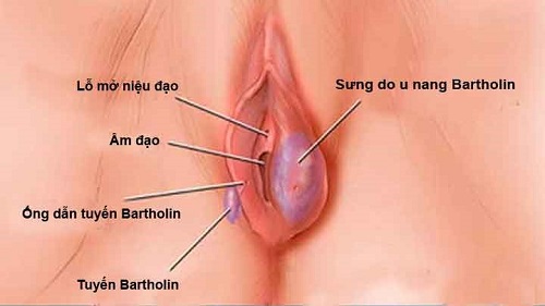 Những điều cơ bản cần biết về bệnh viêm tuyến bartholin